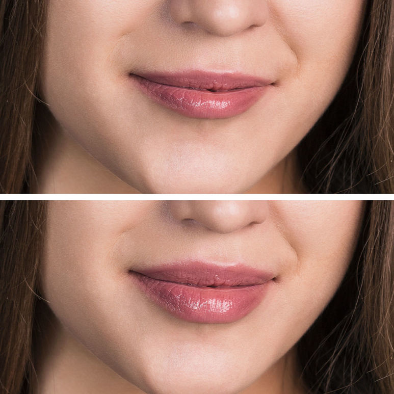 Можно ли накачать мышцы губ фото до и после