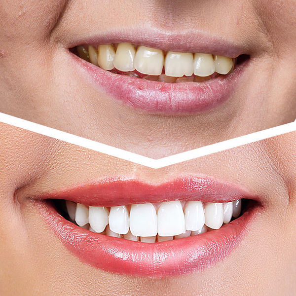 Топ−6 продуктов, которые могут незаметно разрушать зубы